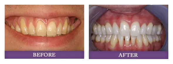 Before and after receding gums surgery