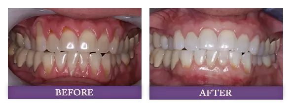 Charolotte gum rejuvenation patient