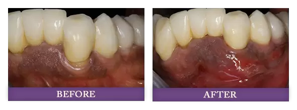 Charlotte NC pinhole gum rejuvenation patient