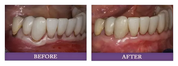 Charlotte pinhole gum rejuvenation treatment patient before and after