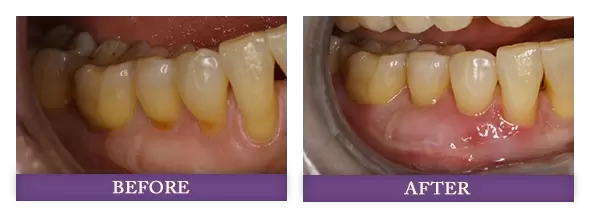 Before and after gum rejuvenation treatment with Dr. Bowman