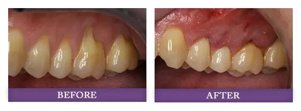 before andafter receiving receding gum rejuvenation treatment