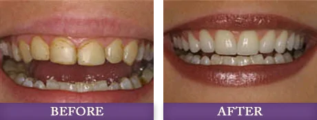 Before and after cosmetic dentistry services at Adanced Dentistry of Charlotte