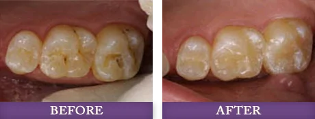 Reconstructive gum surgery patient before and after photos