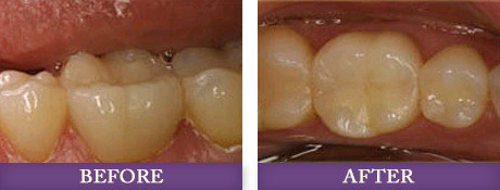 Cosmetic and restorative dentistry repair and maintenance before and after photos