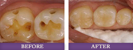 Replacing amalgam fillings with Dr. Chris Bowman at Advanced Dentistry of Charlotte