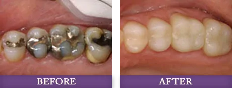 Tooth colored fillings replacing dental amalgam fillings photos