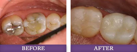 Dental filling repair and replacement with Dr. Bowman