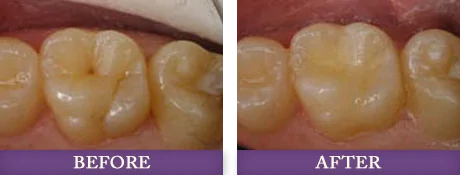 Cracked and chipped tooth repair photos of Charolotte dentist patient