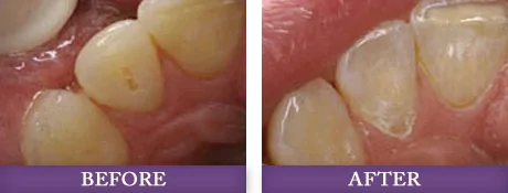 Before and after gum contouring treatment at Advanced Dentistry of Charlotte