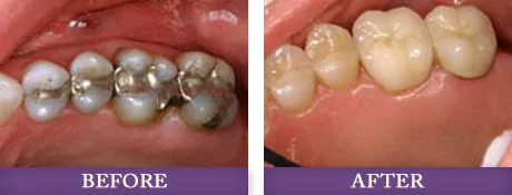 Dental fillings and replacement fillings patient in Charlotte