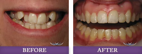 Restorative dentistry patient before and after photos at Advanced Dentistry of Charlotte