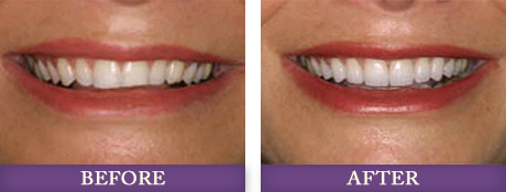 Before and after smile restoration photos with Charlotte dentist Dr. Chris Bowman