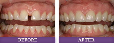 Patient with large gap in in front teeth fixed with orthondics in Charlotte