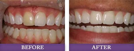 Before and after photos of patient with white teeth at Advanced Dentistry of Charlotte