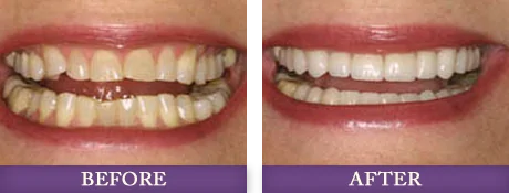 Patient photos of cosmetic dentistry procedure at Advanced Dentistry of Charlotte