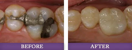 Charlotte dentist replacing and repairing amalgam dental fillings