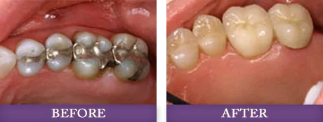 Before and after dental fillings replacement with Dr. Bowman near Dilworth