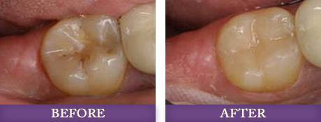 Before and after photos with Charlotte dentist Dr. Chris Bowman