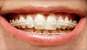 Close up of Six Month Smiles clear braces available to patients in Charlotte