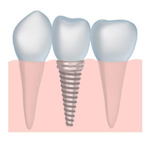 Diagram of a tooth implant available to patients seeking dental implants in Charlotte.