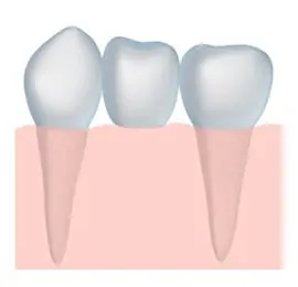 Diagram of a quality dental bridge that helps to restore smiles for patients in Charlotte