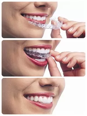 clear brace for teeth straightening with a Charlotte dentist