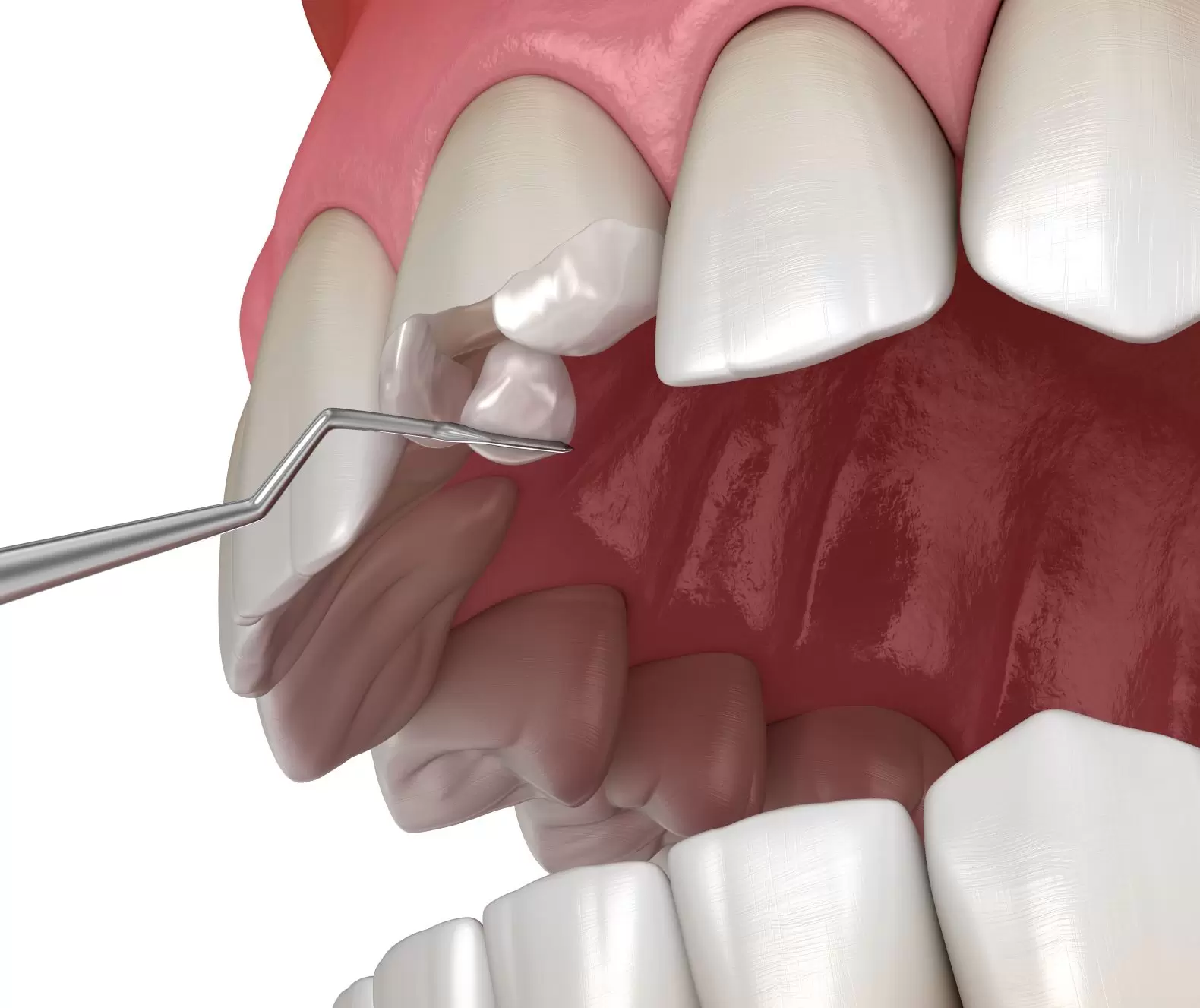 Chipped Tooth Repair - Cosmetic Dental Bonding - Advanced Dentistry of Charlotte