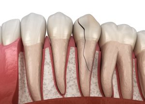 Broken and Cracked Tooth Repair - Restorative Dentistry - Advanced Dentistry of Charlotte