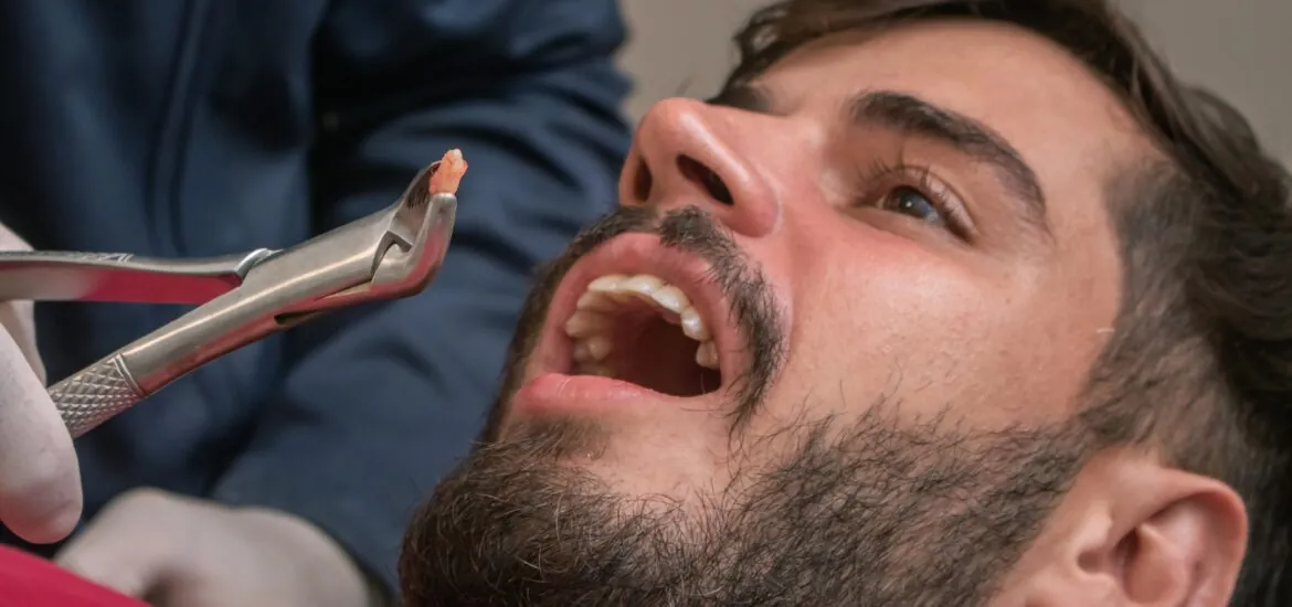 man having a tooth pulled in Charlotte