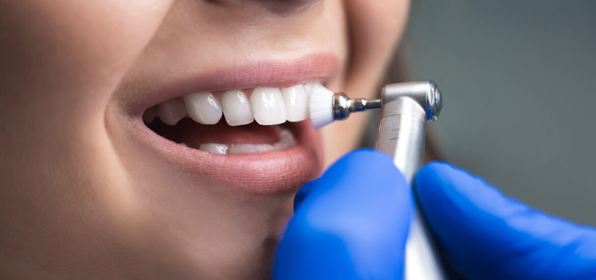 dentist in blue gloves bonding a tooth