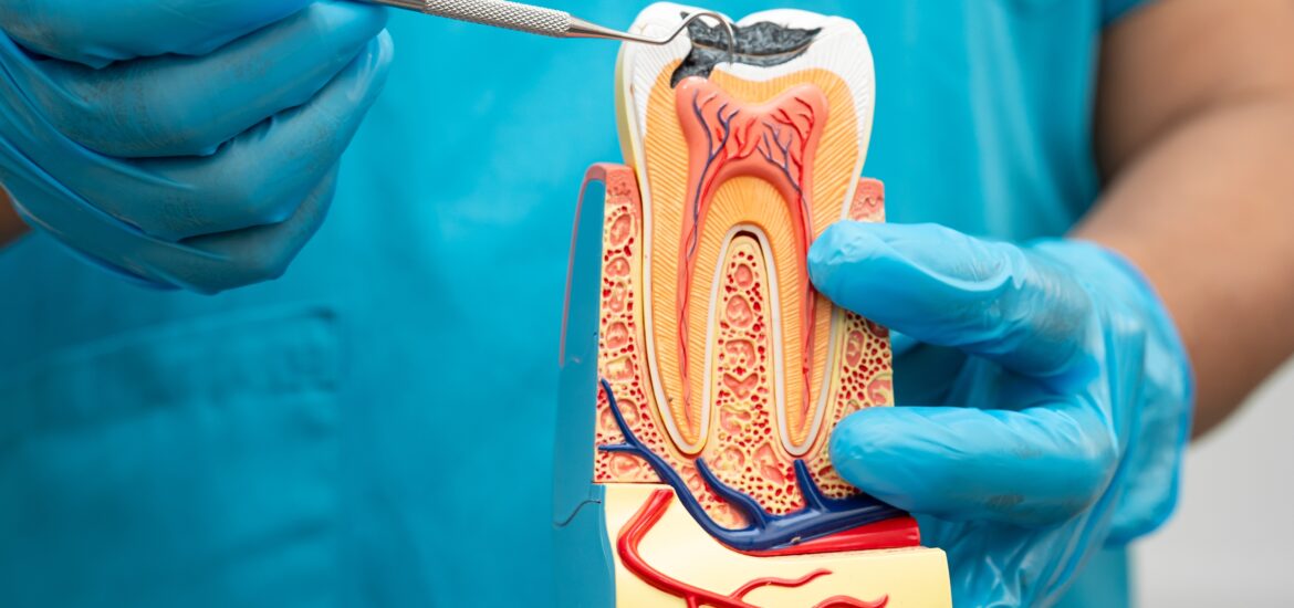dentist in blue gloves showing a model of a root canal