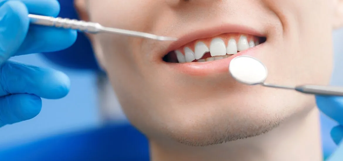 Closeup man smile mouth with broken tooth at reception at dentist, concept of healthy smile