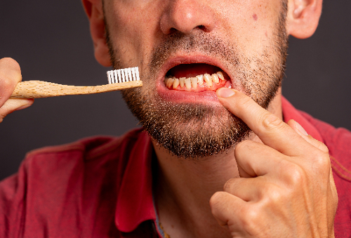 closeup of a man brushing bleeding gums, early gum disease