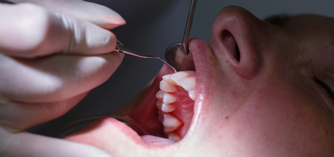 Patient at dentists office, getting soft-tissue probed and teeth cleaned of tartar and plaque, preventing periodontal disease