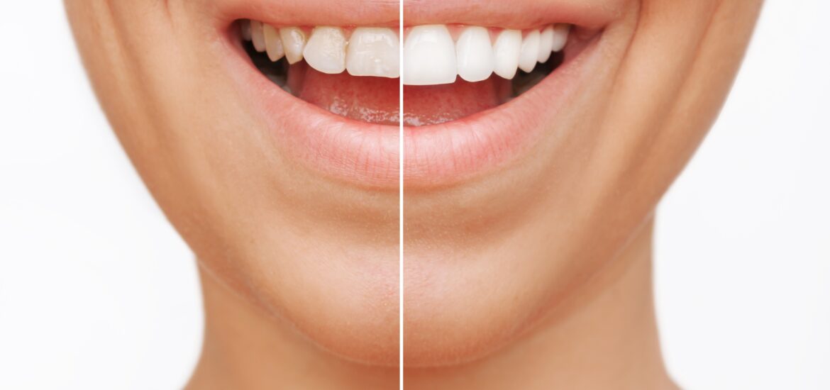 cropped side by side of dental veneers