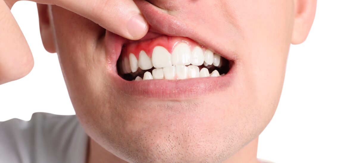 man showing swollen gums against a white background