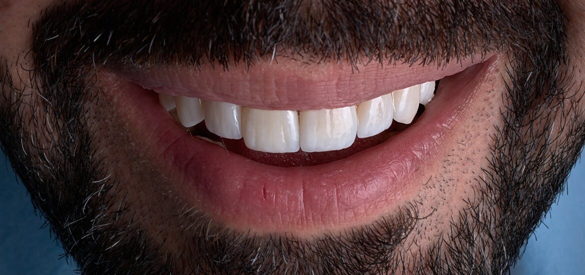 closeup of a cosmetic enhancement, dental bonding